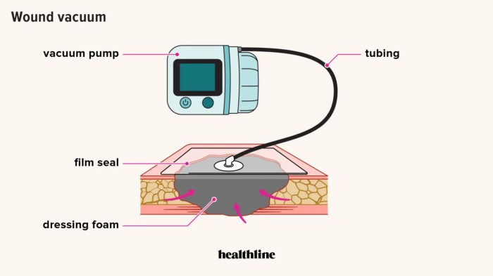 Wound vac black foam on skin