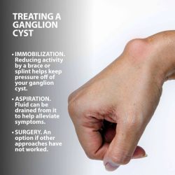 Aspiration cyst ganglion sternoclavicular