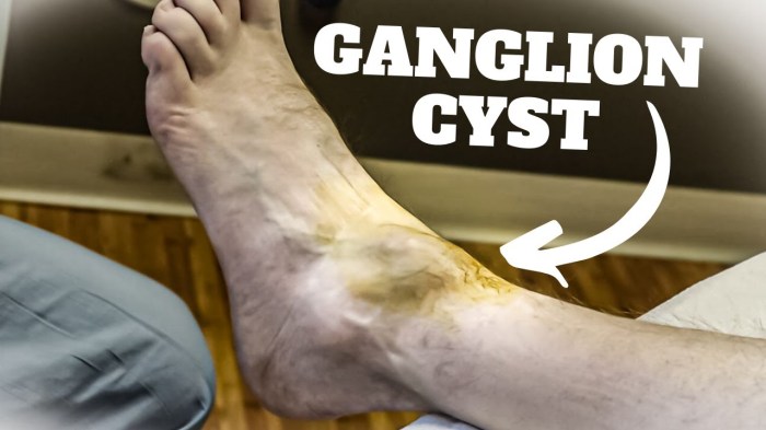 Aspiration of ganglion cyst cpt code